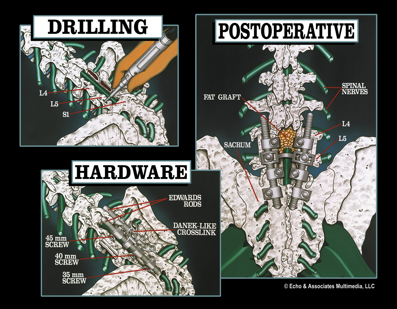 Spinal Surgery Diagram